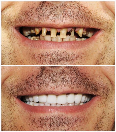 Before and after. Picture of heathy and bad teeth #Sponsored , #ad, #paid, #Picture, #bad, #teeth, #heathy Dental Bridge Cost, Dental Pictures, Cosmetic Dentistry Veneers, Dental Posters, Dental Aesthetics, Bad Teeth, Restorative Dentistry, Teeth Implants, Dental Bridge