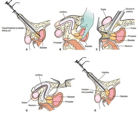 TURP (transurethral resection of the prostate) medical abbreviation Telescopic Resection of the Prostate involves coring out your prostate gland to improve the flow of urine, TURP is the most commonly performed operation to improve urine flow and most men get good relief of their symptoms. A bladder catheter is used for a short time after the operation to wash out blood clots. Prostate Gland, Patient Education, Medical Technology, Medical, Education