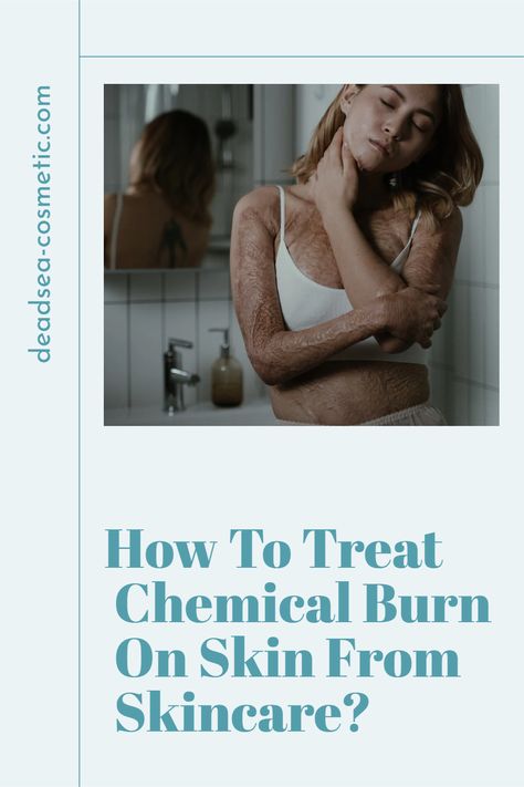 How To Treat Chemical Burns from Skincare: A Comprehensive Guide Did you know you could get a chemical burn from your skincare products? No need to panic! Our comprehensive guide covers everything from symptoms to treatments. Pin this for a step-by-step guide on what to do in case of a skincare mishap. Chemical Burn, Treat Burns, Skin Burns, Beauty Natural Products, Skin Remedies, Bath And Body Care, Chemical Peel, A Nightmare, Facial Wash