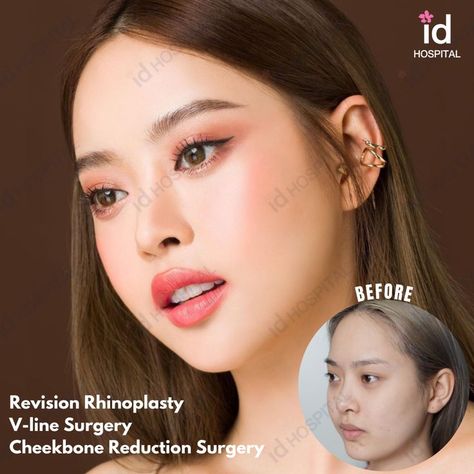 Rhinoplasty revision V-Line Surgery Cheekbone reduction surgery #idhospitalkorea #koreanplasticsurgery #plasticsurgery #plasticsurgerykorea #cosmeticsurgery #seoul #korea #IDtransformation #IDbeforeandafter #plasticsurgerybeforeandafter #beforeandafter #beforeandaftersurgery #besttransformation #vline #vlinesurgery #vshapeface #facialcontouring #cheekbonereduction #rhinoplasty #nosejob #asianrhinoplasty #asiannosejob #barbierhinoplasty #asianrhinoplastysurgeon #rhinorevision Cheekbone Reduction, V Line Surgery, Plastic Surgery Korea, Korean Plastic Surgery, V Shape Face, Rhinoplasty Surgery, Reduction Surgery, Facial Contouring, V Line