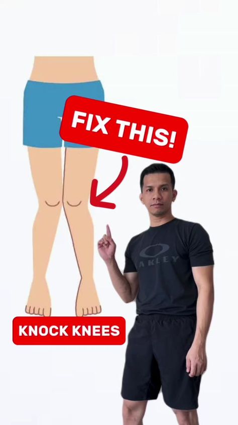 Fix your knock knees with these exercises! FOLLOW FOR MORE REMEDY TIPS! - Disclaimer: It's important to note that the exercises provided here are not intended as a solution for congenital knock knees or severe bone alignment issues. If you have such conditions, it is advisable to consult a medical professional for proper evaluation and guidance. These exercises are meant to offer general tips and support for overall leg strength and flexibility, but they may not address underlying structural c Knock Knees Exercises, Knee Strengthening, Knock Knees, Knee Strengthening Exercises, How To Strengthen Knees, Knee Exercises, Strengthening Exercises, Fix You, Medical Professionals