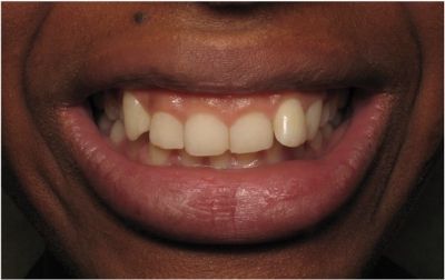 If the amount of gum tissue displayed is between 25% and 50% of the length of the teeth, it is considered a moderate gummy smile. Gummy Teeth, Gummy Smile, Songs