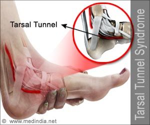 Patients with tarsal tunnel syndrome suffer from a burning or tingling sensation, numbness, and/or a sharp and shooting pain along the distribution of the tibial nerve. Foot Pain Chart, Tibial Nerve, Tarsal Tunnel, Nerve Conduction Study, Foot Anatomy, Middle Back Pain, Ankle Surgery, Pinched Nerve, Ankle Pain