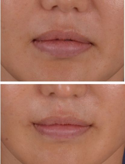 One of the best mouth corner lifting and lip reduction surgery ever http://blog.naver.com/kiaps1/220021460744 Corner Lip Lift, Lip Corner Lift, Lip Reduction, Face Injections, Lip Lift, Botox Lips, Pretty Nose, Reduction Surgery, Lip Cosmetics