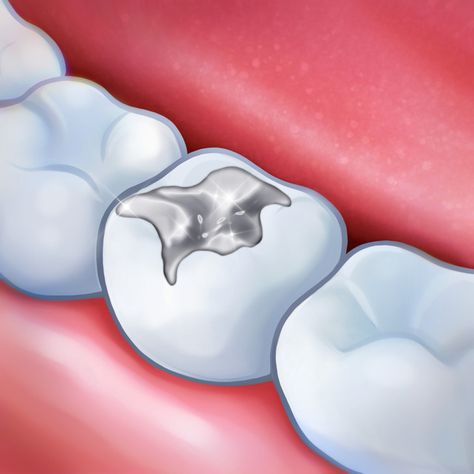 Filling Teeth, Teeth Filling, Composite Fillings, Hypodermic Needle, Dental Assisting, Tooth Filling, Dental Fillings, Personal Hygiene, Medical Students