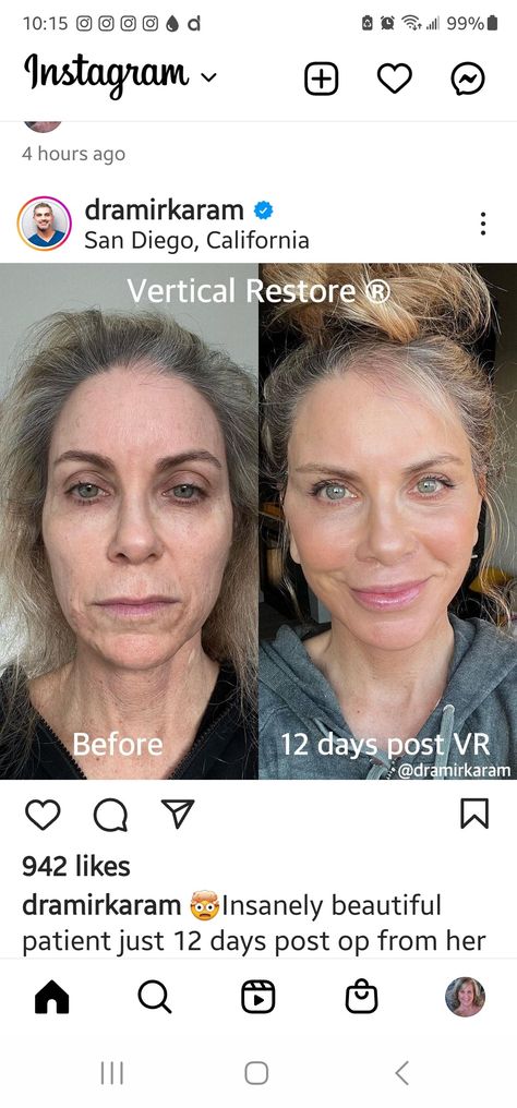 Vertical Restore Facelift, Ponytail Facelift, Fairy Cabin, Facelift Recovery, Face Surgery, Face Lift Surgery, Blue Fairy, Face Lift, Cosmetic Procedures