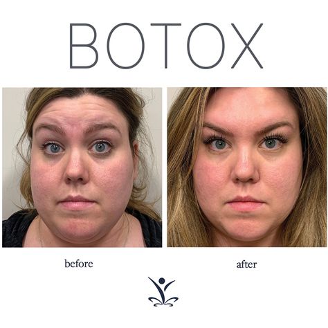 Botox Forehead, Botox Results, Botox Brow Lift, Botox Before And After, Botox Lips, Botulinum Toxin, Botox Fillers, Botox Injections, Brow Lift