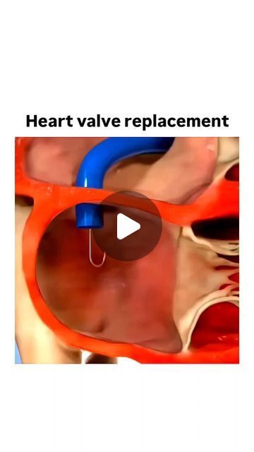 World Of Biology on Instagram: "Heart valve replacement 👇

Heart valve replacement is a surgical procedure where a diseased or damaged heart valve is replaced with a new one, either biological (made from animal tissue or human donor valves) or mechanical (made from artificial materials).

The heart has four valves that control blood flow:

1. Mitral valve
2. Tricuspid valve
3. Aortic valve
4. Pulmonary valve

Valve replacement is usually done to treat conditions like:

- Stenosis (narrowing)
- Regurgitation (leaking)
- Mitral prolapse
- Endocarditis (infection)

The surgery can be:

- Open-heart surgery (traditional)
- Minimally invasive surgery
- Transcatheter aortic valve replacement (TAVR, for aortic valves)

The goal is to restore proper blood flow, alleviate symptoms, and improve qua Animal Tissue, Aortic Valve Replacement, Heart Valve, Tricuspid Valve, Mitral Valve, Heart Valves, Open Heart Surgery, Instagram Heart, Heart Surgery