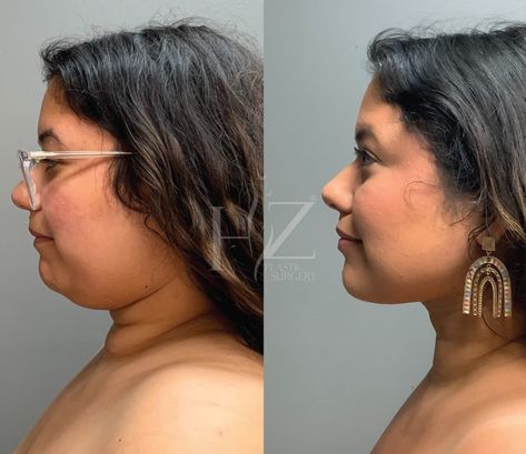 A little lipo can go a loooong way 👏 Swipe through our chin liposuction gallery to see the impact of one of our increasingly popular procedures. Consults available as soon as NEXT week! 🗓️ 1: By @drlylyhzps at 6 weeks post-op 2: By @drlylyhzps at 6 weeks post-op 3: Plus Renuvion by @drlylyhzps at 12 days post-op 4: Plus Renuvion by @drafsharihzps at 3 weeks post-op 5: By @drlylyhzps at 6 weeks post-op 6: By @drzhzps at 3 months post-op 7: Plus Renuvion by @drafsharihzps at 3 months post-o... Chin Lipo Before And After, Lipo 360 Before And After, Lipo 360, Lipo Before And After, Mommy Makeover, Post Op, Cosmetic Procedures, Week 1, 12 Days