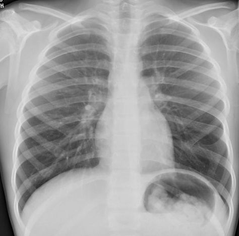 Bifid ribs | Radiology Case contributed by Dr Jeremy Jones | Radiopaedia.org Chest Xray Interpretation, Lung Xray, Deftones Collage, Abby Diamond, Chest Xray, Endometrial Carcinoma, Pericardial Effusion, Subclavian Artery, Xray Art