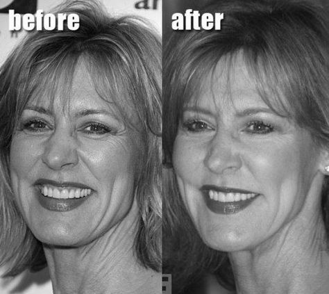 Christine Lahti Plastic Surgery Christine Lahti, Lady L, Old Lady, Golden Globe, Sagging Skin, Cosmetic Surgery, Plastic Surgery, Going Crazy, Celebrity Photos