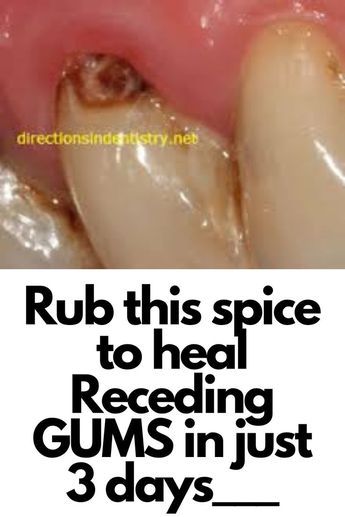 Tooth Scaling, Grow Back Receding Gums, Fix Teeth, Tooth Decay Remedies, Teeth Whitening Diy, Teeth Health, Oral Care Routine, Gum Care, Receding Gums