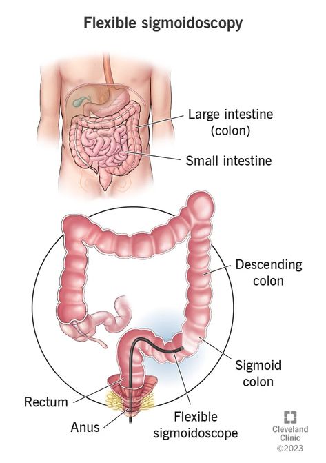 This short procedure looks inside just the lower part of your colon, rectum and anus. Clear Liquid Diet, Lower Abdominal Pain, Sigmoid Colon, Red Hair Trends, Passing Gas, Gastrointestinal System, Liquid Diet, Cleveland Clinic, Large Intestine