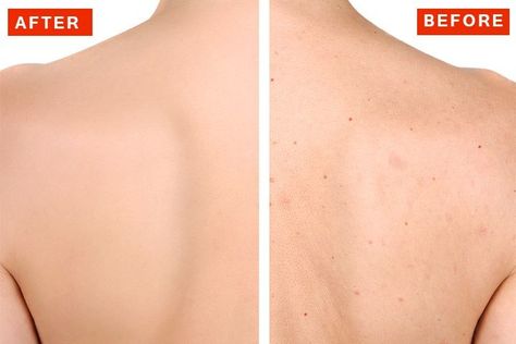 How To Get Rid of Back Acne Get Rid Of Back Acne, Rid Of Back Acne, Back Acne Remedies, Chest Acne, Back Acne, Forehead Acne, Acne Face Wash, Natural Acne Remedies, Natural Acne