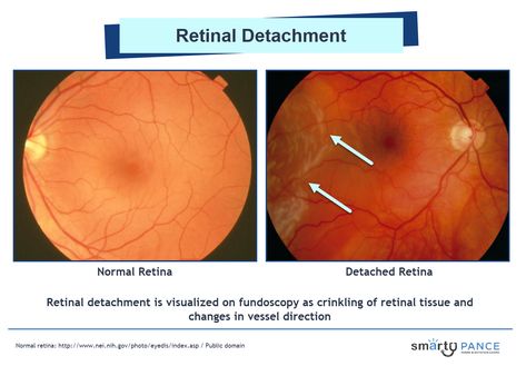 Retinal detachment - comparison between a normal retina and a detached retina Paper Lamp, Novelty Lamp, Quick Saves