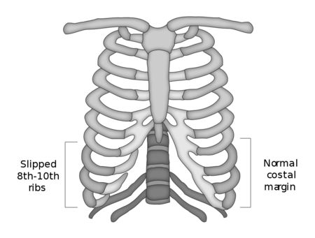 Slipping Rib Syndrome, Ehlers Danlos Syndrome Hypermobility, Occipital Neuralgia, Rib Tips, Abdominal Surgery, Mri Scan, Ehlers Danlos Syndrome, Chest Pain, Primary Care