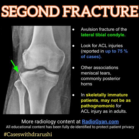 Knee Mri, Avulsion Fracture, Radiology Schools, Medical Radiography, Acl Injury, Meniscal Tear, Radiology Student, Anterior Cruciate Ligament, Radiology Imaging