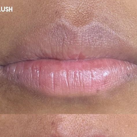 Nika | LA Microblading + Lip Blush Artist on Instagram: "Hyperpigmentation of the lips can be a concern for many, leading to uneven tone, dark spots, and a less defined lip line. Lip blush, a semi-permanent cosmetic tattoo, offers a beautiful solution that can enhance the appearance of hyperpigmented lips. Here are some key benefits:

	1.	Even Skin Tone: Lip blush can help correct and neutralize uneven pigmentation, providing a more uniform color across your lips. It enhances your natural lip shade, creating a consistent and balanced tone.
	2.	Enhanced Lip Definition: By defining the borders of your lips, lip blush creates a fuller and more symmetrical appearance. This is particularly beneficial for those with undefined or faded lip lines due to hyperpigmentation.
	3.	Long-Lasting Results: Natural Lip Shades, Lip Shade, Lip Line, Permanent Cosmetics, Lip Blush, Cosmetic Tattoo, Lips Shades, Natural Lip, How To Line Lips