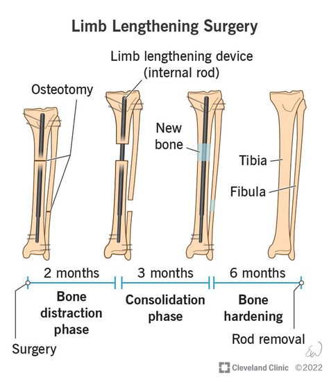 Limb lengthening surgery is a procedure that can make an arm or leg bone longer. 🦵 Surgeons may perform limb lengthening surgery on the: - Humerus (upper arm bone). - Radius/ulna (forearm bones). - Femur (thigh bone). - Tibia (shin bone). If you are curious of limb lengthening surgery check out our article below. 👇 Forearm Bones, Limb Lengthening, Radius And Ulna, Arm Bones, Leg Bones, Skeletal System, Medical Illustrations, Cleveland Clinic, Leg Sleeve