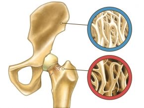 Vitamin D Deficiency Symptoms, Osteoporosis Exercises, Magnesium Deficiency Symptoms, Hip Problems, Weight Bearing Exercises, Dandelion Tea, Bone Diseases, Vitamin D Deficiency, Magnesium Deficiency