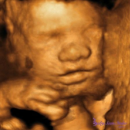 http://www.babyscanstudio.com/prices-extras/reassurance-ultrasound-scan?utm_content=bufferd3f1e&utm_medium=social&utm_source=pinterest.com&utm_campaign=buffer From 13 to 40 weeks you can book a reassurance scan with us. Just give us a call. #baby #babyscan #kent #ashford  #baby #babyscan #babyscanstudio #Ashford #Kent #4d #3d #pregnant #pregnancy #London #Maidstone #Canterbury #3months #4months #5months #6months #25weeks #26weeks #27weeks #28weeks #29weeks #30weeks #2ndtrimester #pregnancyscan … Call Baby, Baby Scan, Canterbury, Ultrasound, A Call, 3 D, London