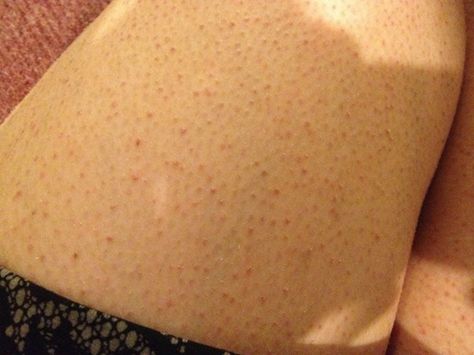 Skin Bumps, Keratosis Pilaris, Chicken Skin, Acne Remedies, Natural Therapy, Skin Remedies, Skin Care Remedies, Upper Arms, Sagging Skin