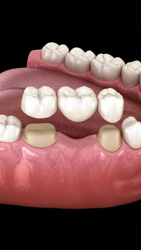 #DentalBridge #ReplaceMissingTooth #DentalImplantAlternative #DentalImplant #IsOralHealthCare #OralDentalCare Dental Wallpaper, Dental Education, Dental Videos, Dental Fun, Partial Dentures, Dental Cavities, Dental Facts, Dental Bridge, Tooth Sensitivity