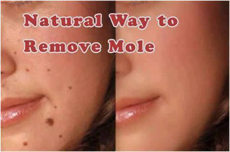 Moles removal Natural Mole Removal, Moles On Face, Skin Moles, Mole Removal, Get Rid Of Warts, Skin Tags, Diy Skin Care Recipes, Skin Care Recipes, Free Life