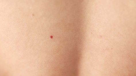 Red Dots On Skin, Red Moles, Skin Moles, Natural Skin Care Remedies, Neck Exercises, Receding Gums, Superbowl Party Food, Laser Therapy, Healthy Smile