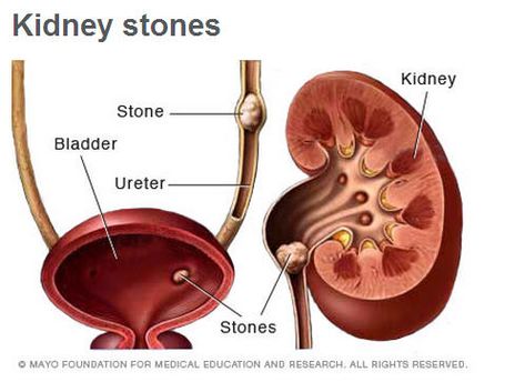 Kidney stones illustration Renal Calculi, The Urinary System, Prostate Surgery, Creatinine Levels, Urinary System, Kidney Stone, Organic Supplements, Chest Congestion, Med Surg