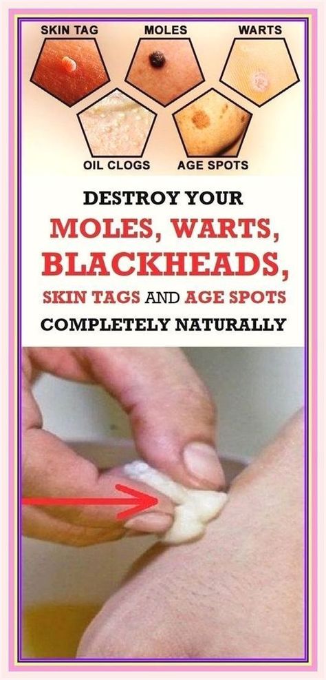 Did You Know that You Are Able to Get Rid of Your Moles, Warts, Blackheads, Skin Tags and Age Spots In a Completely Natural Way?!? Skin Moles, Get Rid Of Warts, Skin Tags, Natural Sleep Remedies, How To Remove Pimples, Cold Home Remedies, Homemade Face Masks, Homemade Face, Skin Complexion