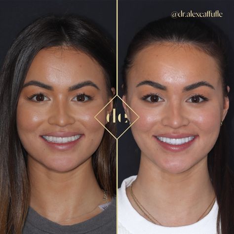 Simple but effective, a true testament to natural beauty🤌🏼 When @stephanielamx visited our clinic, we were keen to create a stunning transformation that perfectly complemented her features. By combining the power of Invisalign, whitening, and composite edge bonding, we enhanced her natural beauty while keeping the results looking flawless💎 DM or click the link to start your journey! https://www.dentalexcellenceuk.com/book Composite Bonding Before And After, Composite Bonding, Teeth Dentist, Perfect Teeth, Natural Beauty, To Start, Composition, Makeup, Beauty