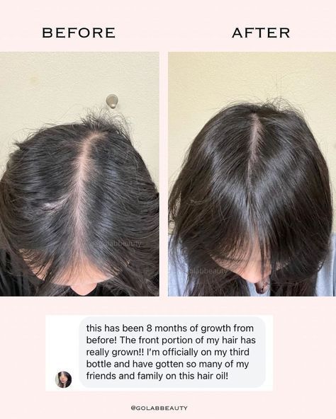 Hair Growth Before And After, Growth Pictures, Hair Growth Pictures, Ideas Selfies, Photography Cosmetics, For Fast Hair Growth, Fast Hair Growth, Healthy Hair Routine, Growing Hair