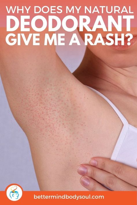 Switching to natural products like deodorants is a bit of a transition process. Especially since some can cause skin irritations and rashes. But it’s usually not the fault of the new natural product. There’s a number of different factors that come into play before landing on allergies. This article touches on all the points to look at when dealing with rashes form natural deodorants, so have a read and see what applies to you and what you can do about it.  #AllNatural  #organic Prickly Heat Rash, Deodorant Alternatives, Armpit Rash, Rashes Remedies, Rash Causes, Sweating Too Much, Prickly Heat, Deodorant Recipes, Underarm Odor