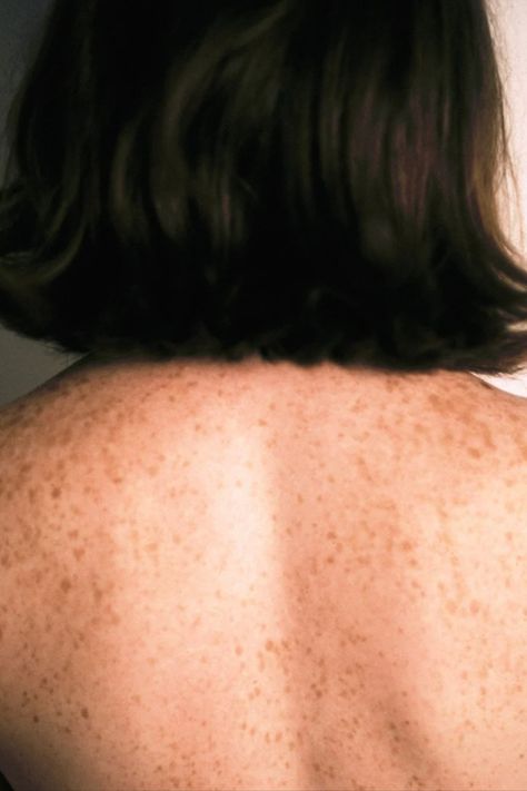 Have you ever spotted a tiny patch of lighter pigment on your skin and became quickly concerned? Us too. The good news is that while most of these white skin spots are related to sun damage, they’re harmless, but they can be aesthetically pesky. We found ourselves wondering why certain spots grow lighter than others on people of all skin tones. It seems it’s also somewhat of a mystery to experts, but here’s what they know. White Skin Spots, Sun Spots On Skin, Body Imperfections, Red Moles, Healthy Book, Coconut Health Benefits, Skin Spots, Baking Soda Shampoo, Black Patch