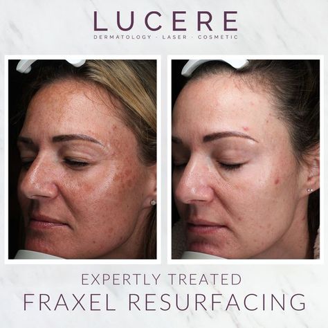 Fraxel Laser, Laser Skin Resurfacing, Acne Scarring, Skin Resurfacing, Laser Skin, Scarring, Cosmetic Procedures, Younger Looking Skin, Dermatology