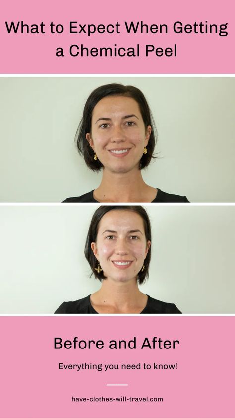 Are you interested in getting a chemical peel but aren't sure what to expect? This post is sharing everything you need to know before and after a chemical peel...plus photos of my face throughout the peeling process. (All of these photos are taken without makeup - to give you the best idea of what my skin looks like.)  | before and after chemical peel photos | chemical peel benefits | chemical peel aftercare #beauty #skincare Chemical Peel Benefits, Chemical Face Peel, Best Chemical Peel, Pca Skin Care, Face Peel, Facial Peel, Pca Skin, Younger Skin, Peeling Skin