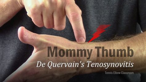 Picture of wrist and back of thumb where De Quervain’s Tenosynovitis pain is felt Thumb Sprain, Carpal Tunnel Surgery, Kt Tape, Soccer Goalie, Carpal Tunnel, Golfers, Health Remedies, Pain Relief, Surgery