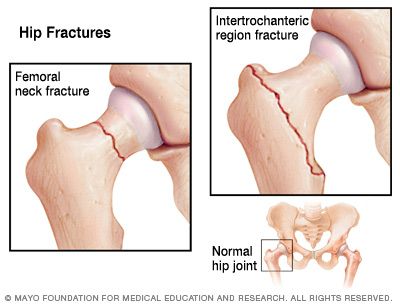 Illustration showing the two most common types of hip fractures Organ Art, Hip Surgery Recovery, Medical Learning, Ortho Nurse, Surg Tech, Orthopedic Nursing, Medical Jokes, Radiology Student, Medical Textbooks