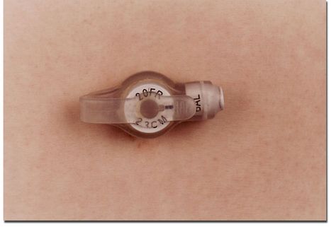 A "Mickey Button" - the "door" to my feeding tube into my stomach.  I feel like a robot. Frozen Bedroom, Button Tattoo, Food Intolerance, Feeding Tube, Food Allergies, Skin