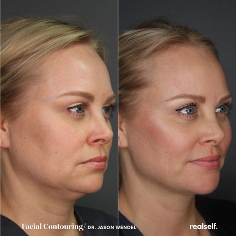 Weak Chin Profile, Jaw Exercises Before And After, Eliminate Double Chin, Chin Lift Before And After, Double Chin Removal Surgery, Chin Injection Before And After, Double Chin Lipo Before And After, Jaw Line Fillers Before And After, Double Chin Before And After