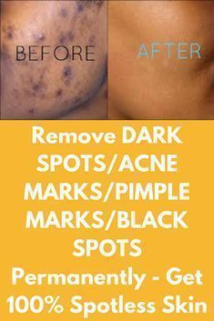 How to get rid of dark spot overnight with natural remedies Acne Holes, Acne Dark Spots, Dark Spots On Face, Home Remedies For Acne, Dark Spots On Skin, Acne Scar Removal, Spots On Face, Pimple Marks, Homemade Beauty