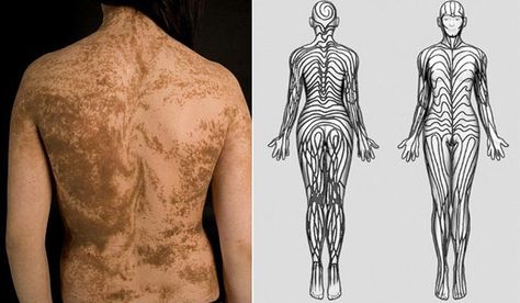 Human skin is actually covered in stripes called Blaschko’s Lines. They cover our body from head to toe. We just can’t see them. They follow a “V” shape over the back, “S” shaped whirls over the chest and sides, and wavy shapes on the head.(1, 2) Human Body And Nature Art, Blaschko Lines People, Blaschko Lines, Human Stripes, Animals With Human Bodies, Human Skin Stripes, Similarities Between Human Body And Nature, Body Representation, Cultist Simulator