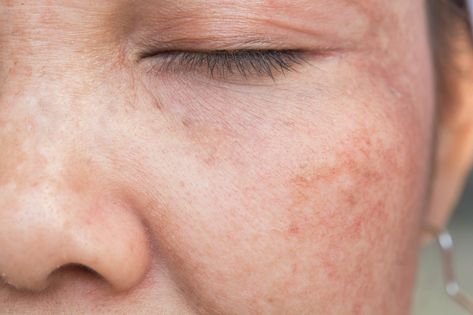 4 Easy Ways To Reduce Sun Damage Now Age Spots On Face, Brown Age Spots, Skin Care Specialist, Treating Hyperpigmentation, Natural Face Mask, Freckle Face, Sun Damaged Skin, Spots On Face, Chemical Peel