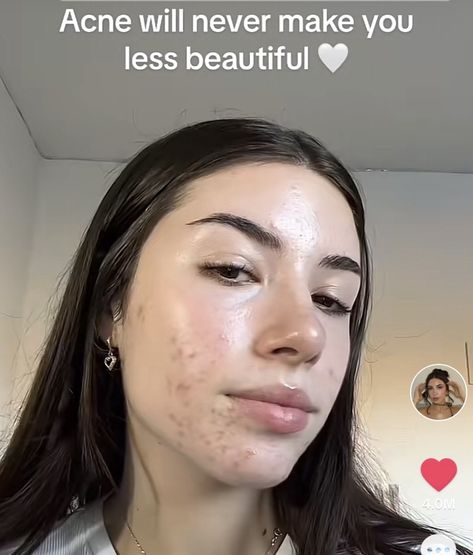 Beautiful Girls With Acne, Embracing Acne, Acne Makeup Looks, Models With Acne, Acne Confidence, Acne Is Beautiful, Pretty People With Acne, Girls With Acne, Celebrities With Acne