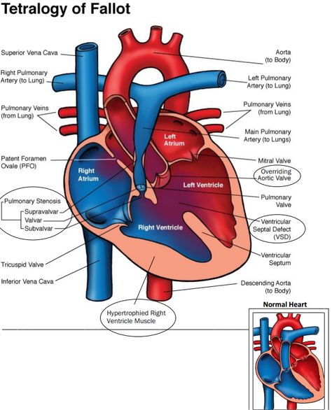 Paramedic Notes, Pediatrics Nursing, Tetralogy Of Fallot, Thoracic Surgery, Obstetrics Nursing, Vascular Ultrasound, Human Heart Anatomy, Procreate Watercolor, Essential Oils For Pregnancy