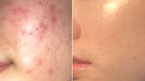 Woman's Skin-Care Routine for Acne Goes Viral - Before and After Photos | Allure Acne Chart, Acne Men, Logo Woman, Everyday Skin Care Routine, Skin Care Routine 30s, Acne Skincare, Night Time Skin Care Routine, Nighttime Skincare, Acne Scar