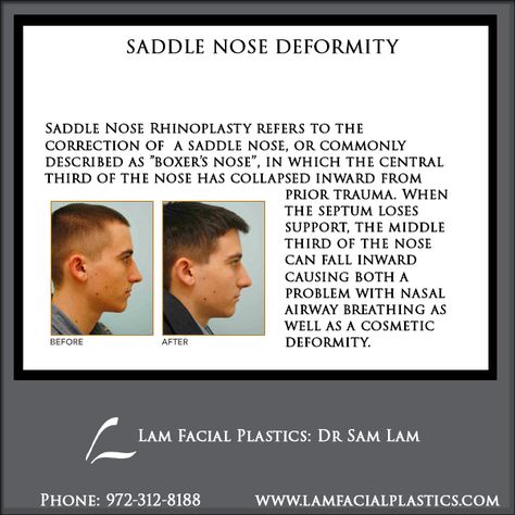 Saddle Nose Rhinoplasty refers to the correction of  a saddle nose, or commonly described as "boxer's nose", in which the central third of the nose has collapsed inward from prior trauma. @LamFacialPlastics #LamFacialPlastics #DrSamLam #PlasticSurgery #DallasPlasticSurgeon #SaddleNoseDeformity #SaddleNoseRhinoplasty Nose Rhinoplasty, Rhinoplasty Nose Jobs, Rhinoplasty Surgery, Nose Surgery, Scientific Articles, Facial Plastic, Nose Job, Stone Cold, The Nose