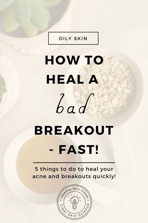 Want to get rid of breakouts quickly? Do these 5 things every time you are having a breakout to heal it super quick! Breakout Remedies, Forehead Acne, Bad Acne, Natural Acne Remedies, Natural Acne, Acne Breakout, Cystic Acne, Acne Spots, Healthy Glowing Skin