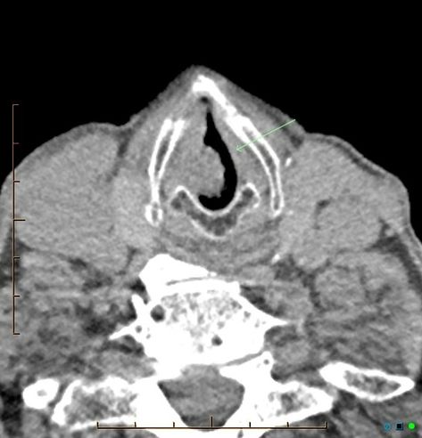 Vocal Cords, Quick Saves